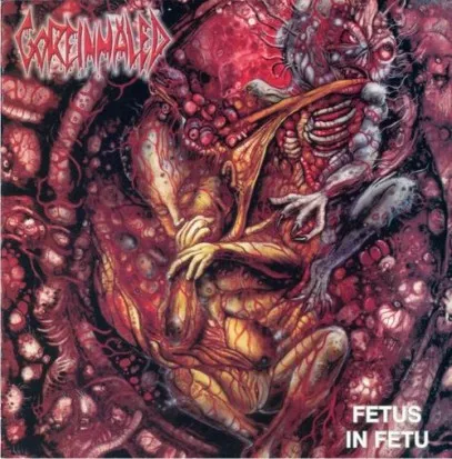Fetus In Fetu