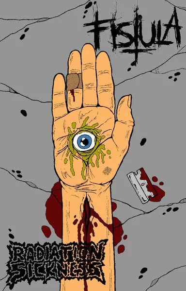 Fistula / Radiation Sickness