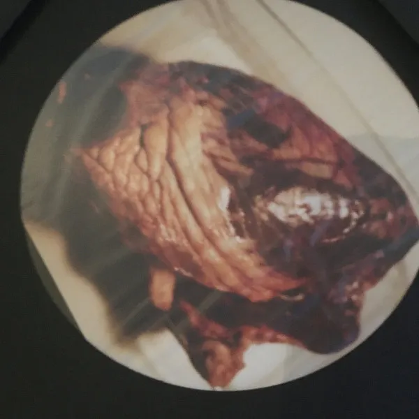 Myocarde LP